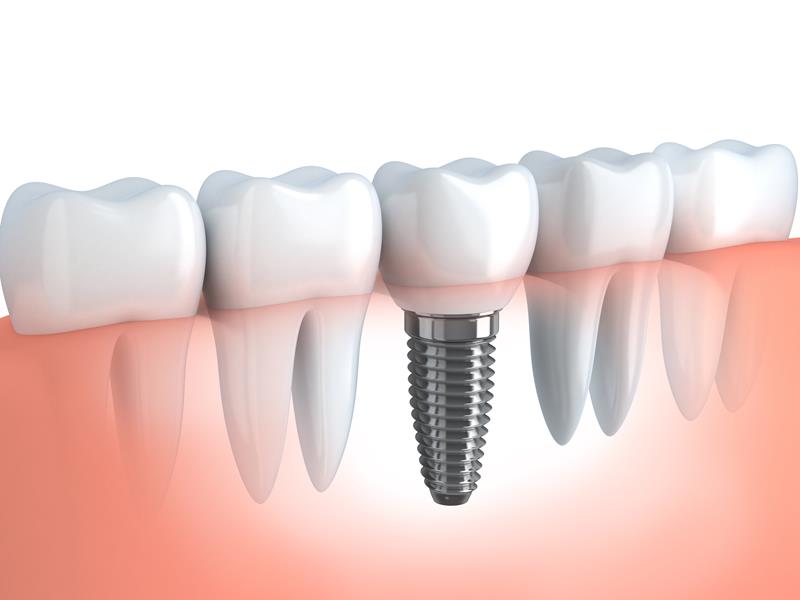 Portland Dental Implants